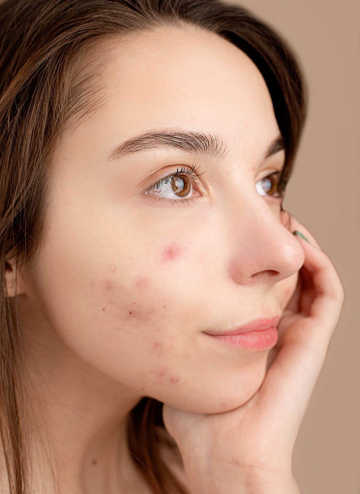 Best acne supplements and skinvite 