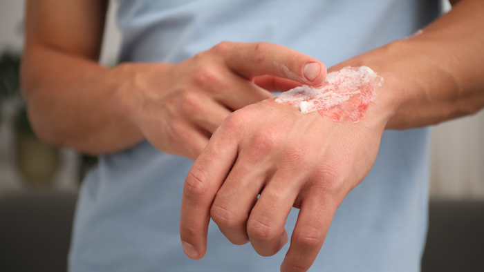 Applying Cream To Healing Skin Wound