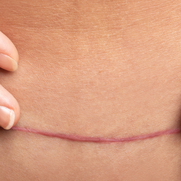Vitamins To Reduce Scars After Surgery