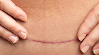 Vitamins To Reduce Scars After Surgery