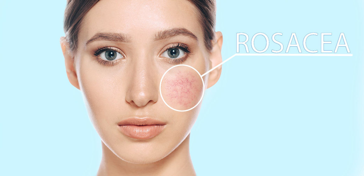 Top 12 Products for Rosacea in 2022