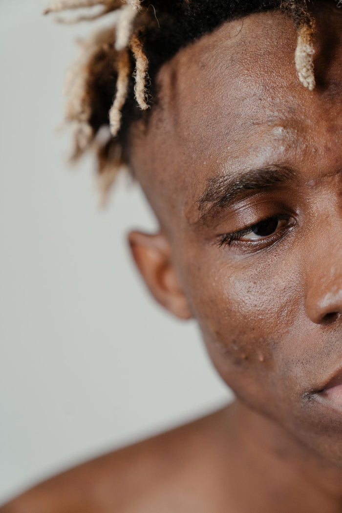Forehead Acne: How To Treat and Prevent Pimples on Forehead