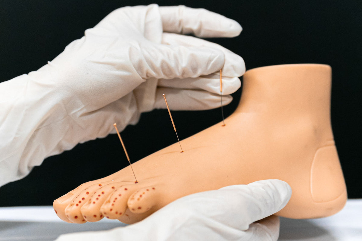 Acupuncture for Neuropathy: Can It Help?