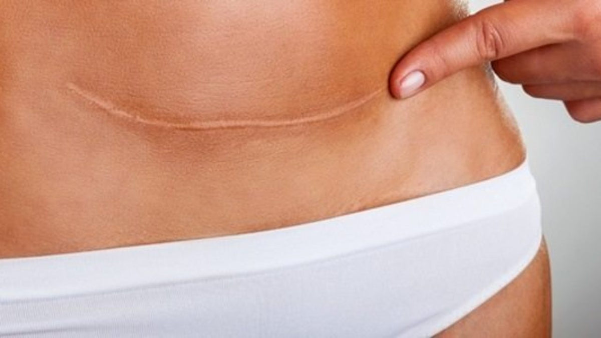 The 5 Best Vitamins To Reduce a Tummy Tuck Scar